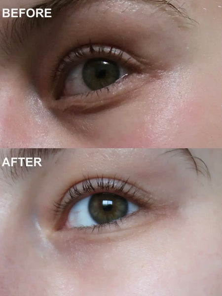 Self Dissolving Microneedle Patches