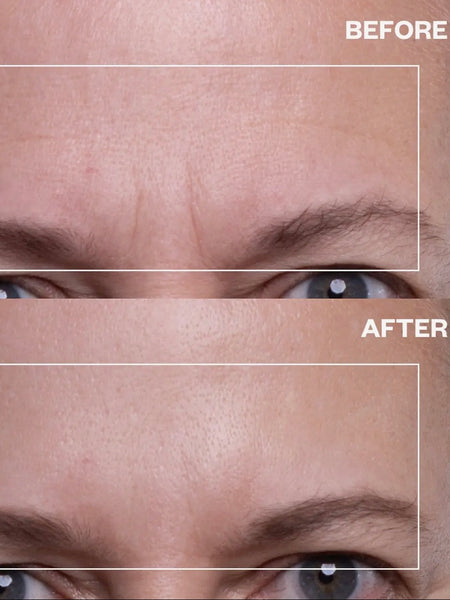 Forehead Wrinkle Patch 2pk