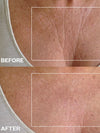 Chest Wrinkle Patch